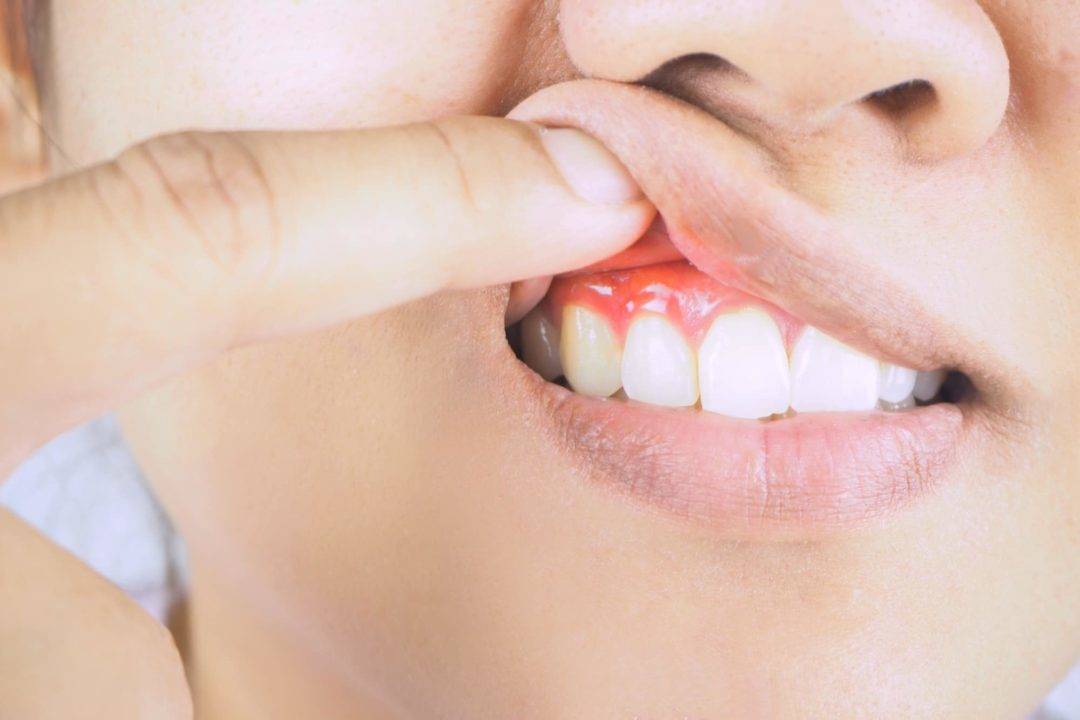 Why Is Gingivitis Different from Periodontitis?
