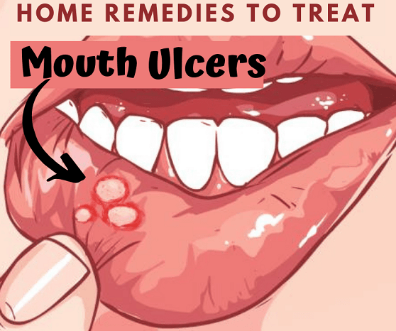 canker sore treatment