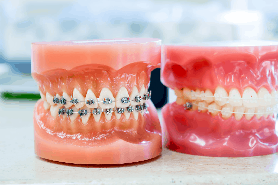 Cost of Metal Braces – Sabka Dentist – Top Dental Clinic Chain In India