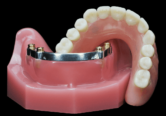 overdenture