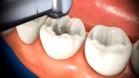 Root canal treatment cost and process