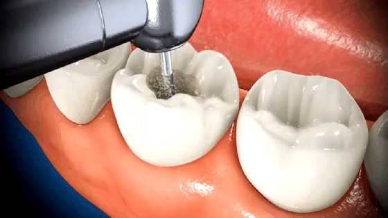 Best Root Canal Treatment Near Me