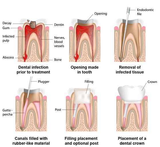 teeth root canal treatment