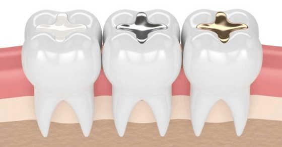 Types-0f-Teeth-Fillings