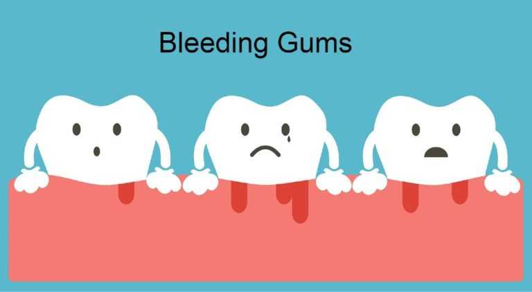 bleeding-gums-treatment