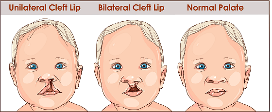 cleft lip and palate.