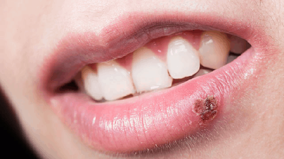 mouth sores problems