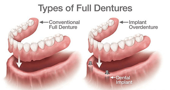 conventional dentures