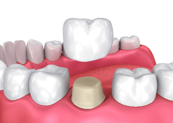 crowns or veneers for front teeth