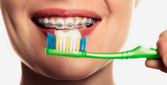 Elastics For Braces – Sabka Dentist – Top Dental Clinic Chain In India