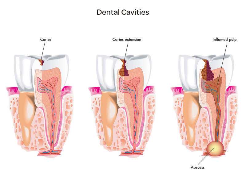 tooth cavity treatment