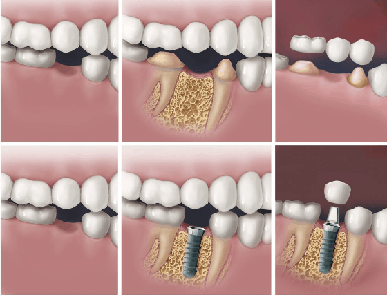 dental implans vs dental bridges