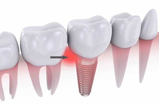 dental implant side effects