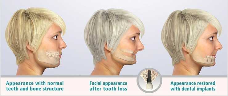 dental-implants-jawbone