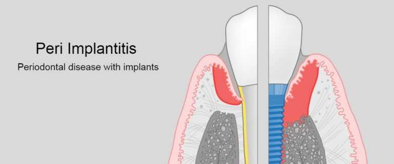 dental-problem-with-implants