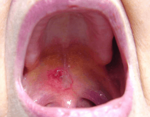 denture ulcer