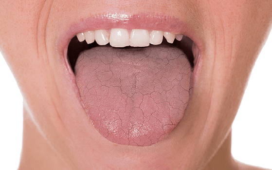 Dry Mouth Causes Symptoms Diagnosis Treatments