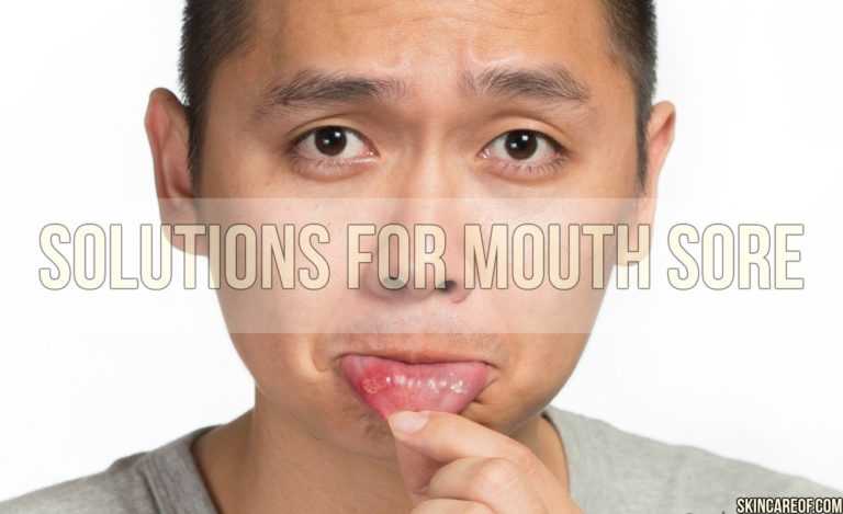 home-remedies-for-mouth-sores