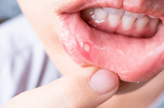 home remedies to get rid of canker sores