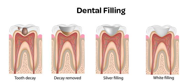 tooth cement filling