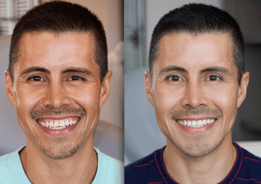 How to Improve the Aesthetics of a Gummy Smile