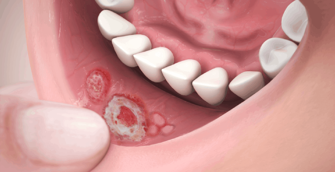 Mouth Cuts - Mouth Lacerations - University Dental Center