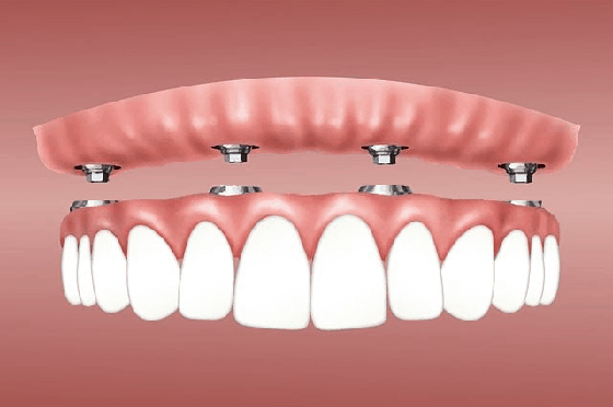 overdenture