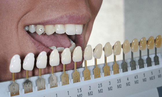 teeth discoloration