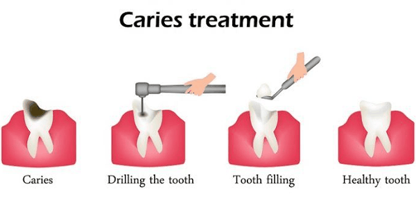 teeth filling steps