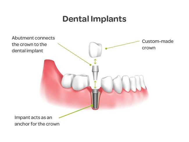 what-are-dental-imlplant