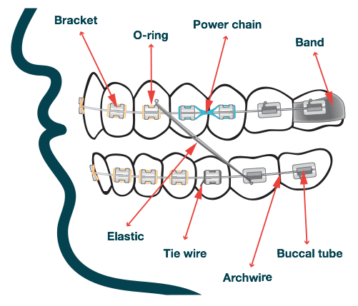 Braces Treatment