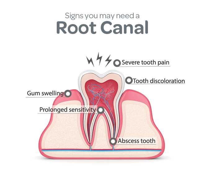 when-do-you-need-root-canal-treatment