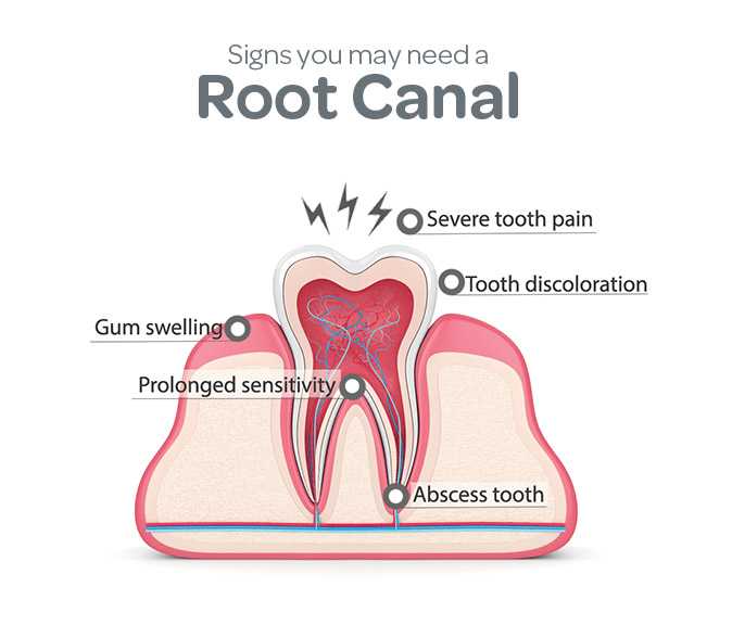 root canal treatment