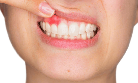 Bleeding gum disease