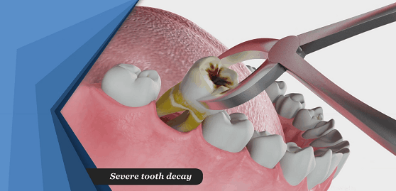 Decayed tooth extraction