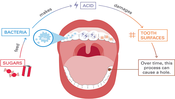 Toddlers: Early signs of tooth decay – Sabka Dentist – Top Dental Clinic  Chain In India