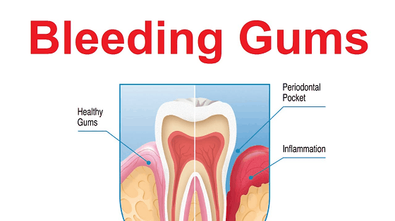 Medicine for bleeding gum