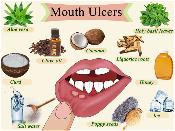 Mouth-Ulcer-Treatment