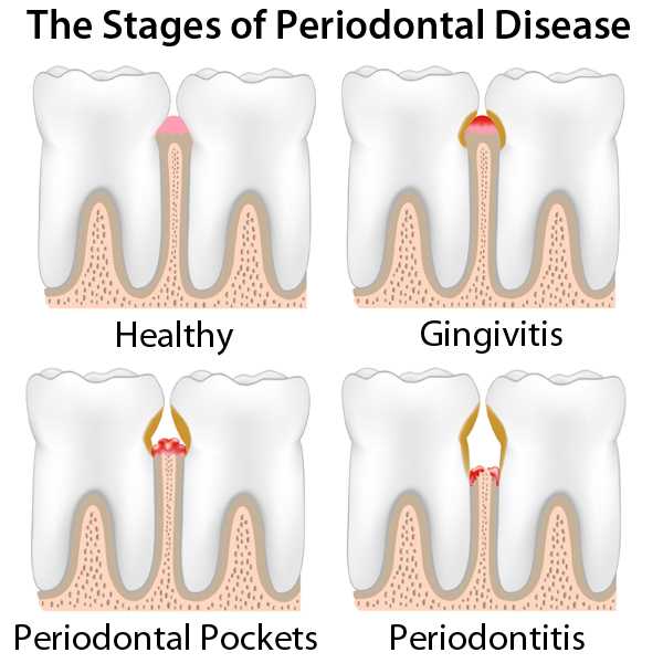 Stages of periodontal disease
