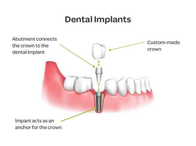 What is dental implant