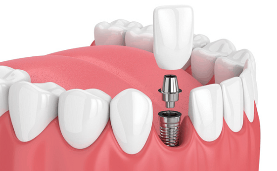 cosmetic dentistry dental implants