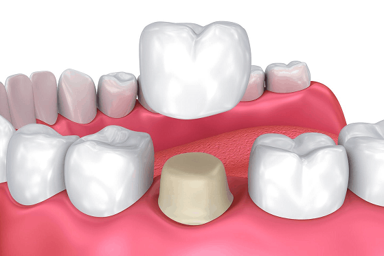 dental crown