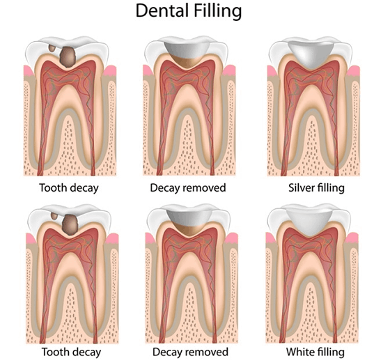 dental filling