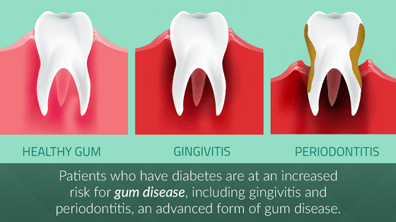 Advice for Diabetes and Dental Awareness