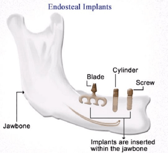 endosteal implants