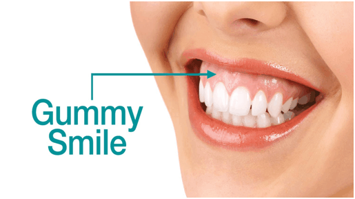how to fix gummy smiles