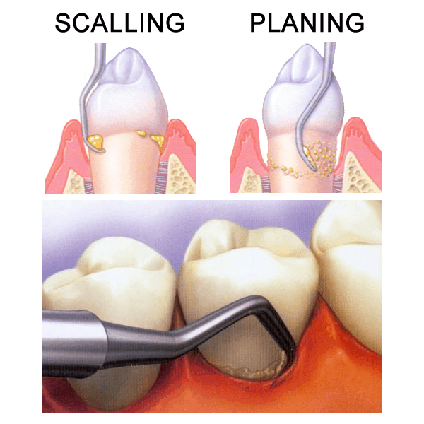 periodontal scaling & planing