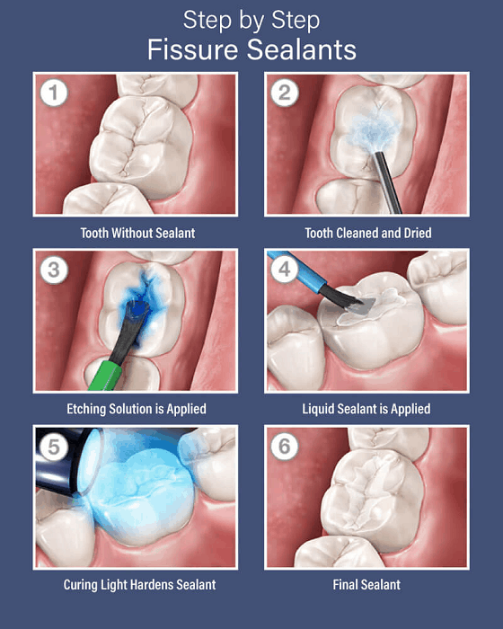 Are Dental Sealants Necessary?