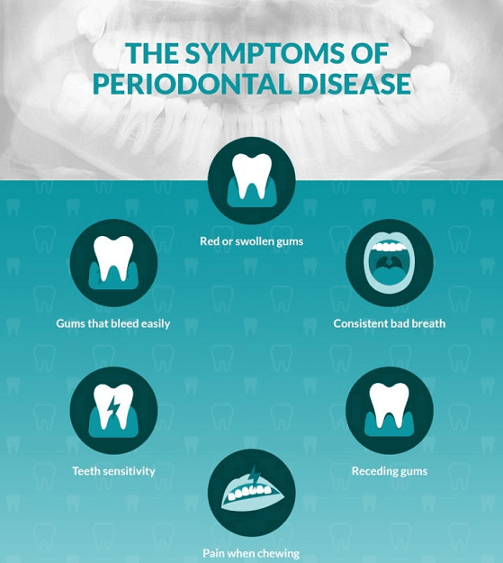 symptoms of periodontal diseases