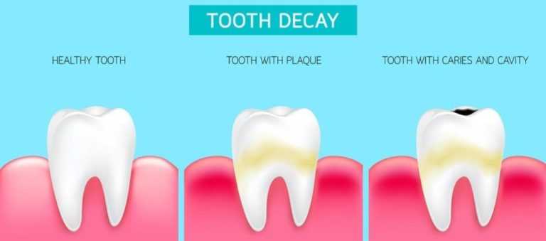 tooth-decay